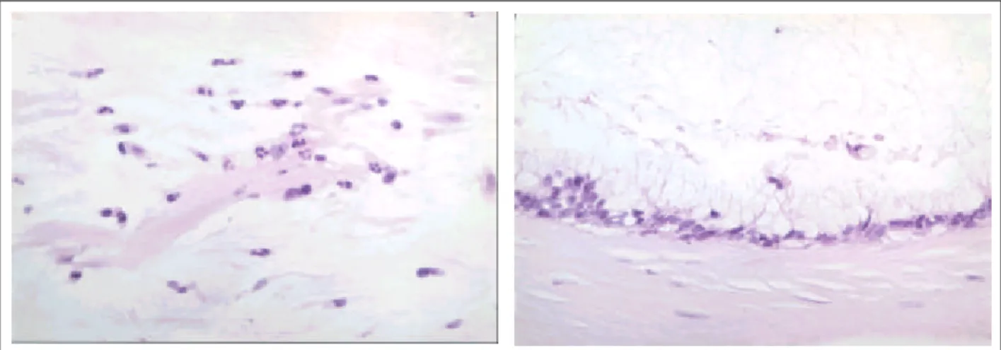 Fig. 1. (A) Operative finding shows gelatinous material and mucinous mass. (B) Computerized to mography of the abdomen shows bowel shifting due to mass and massive ascites.