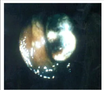 Fig. 3. Abdominal CT shows abnormal diffuse bowel wall thickening with fatty infiltration and re gional lymph no de enla rgement ( A) and m ultip le small low attenuated lesion at liver suggesting liver metastasis (B).