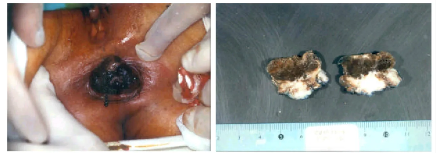 Fig. 4. Microscopic finding reaveals junctional activity and melanophage in the entire epidermis and upper dermis (H&amp;E 40).