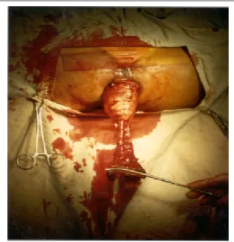 Fig. 4. Mucosectomy was carried proximally until the limits of dissection was met.