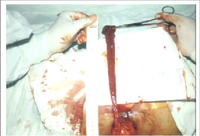 Fig. 5. The picture of complete dissection. The length of dis- dis-section was 26 cm in this case.