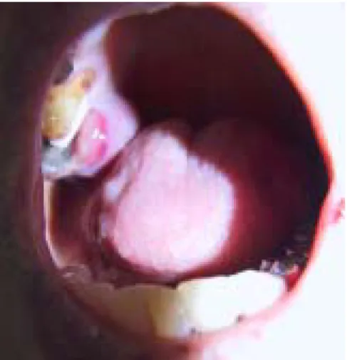 Fig.  1.  It  shows  the  gingival  mass  at  right  maxillary  sinus.