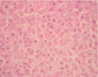 Fig. 3. Biopsy  of  posterior  mediastinal  (A,  H  &amp;  E,  ×100),  and  gingival  (B,  H  &amp;  E,  ×200)  mass  shows  the  diffuse   pro-liferation  of  plasma  cells.