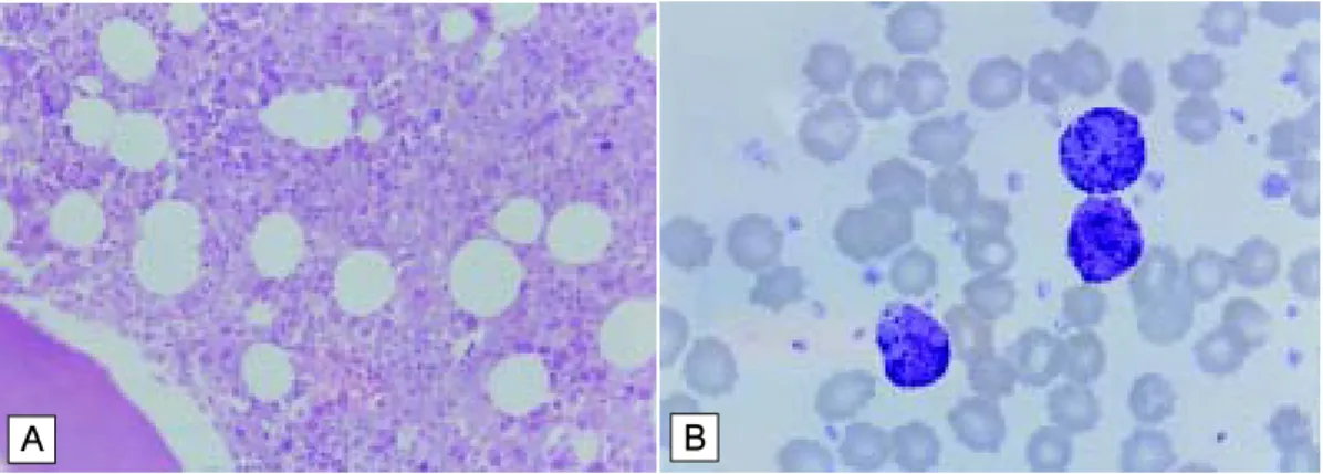 Fig. 2.  A) Bone  marow  biopsy  at  the  time  of  diagnosis  (H&amp;  E  stain,  ×400)