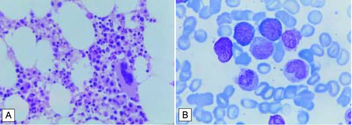Fig. 4.  A) Bone  marow  biopsy  after  3  months  of  therapy  with  STI571  (H&amp;E  stain,  ×400)