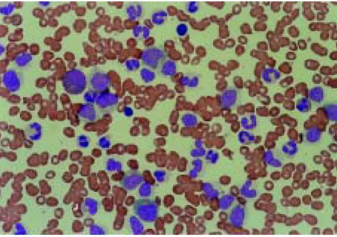 Fig.  1.  Peripheral  blood  smear  shows  leukocytosis  with  com- com-plete  spectrum  of  neutrophils  and  hypogranulation  of   pro-myelocytes  (Wright  stain,  ×400).