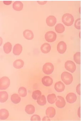Fig.  2.  Results  of  platelet  aggregation  test  in  response  to  ristocetin  (A),  collagen  (B),  ADP  (C)  and  epinephrine  (D)
