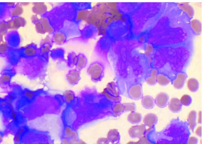 Fig. 2. Pleural  fluid  of  case  2  shows  malignant  lymphoid  cells  having  very  large  size,  pleomorphic  and  bizarre  nuclei  with  multiple  nucleoli  (Wright  stain,  ×400).