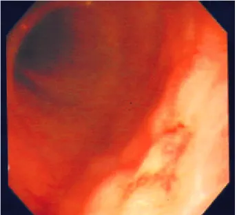 Fig . 1. Endoscopic finding s hows s ha llow ulce r with exudate .