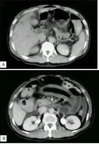 Fig . 1. Abdomina l X- ray s hows multiple gas dilatation in dif- dif-fuse bowe l wa ll thicke nings .