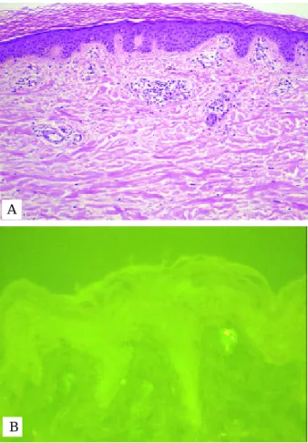 Fig . 4 . The micros copic exa mination of s kin biopsy s hows the le ukocytocla stic vas culitis (H&amp;E, ×200) (A)