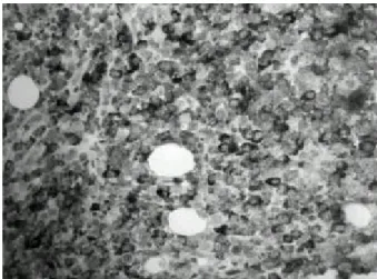 Fig . 1. Bone ma rrow as pirate s hows les s conde ns ed chro- chro-matin, promine nt nucleoli a nd prolife ration of immature  plas-ma ce lls (Wright sta in, ×40).