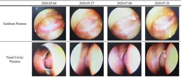 Fig.  3.  Clinical  Progress  of  Otitis  Media  with  Effusion  and  Chronic  Rhinitis