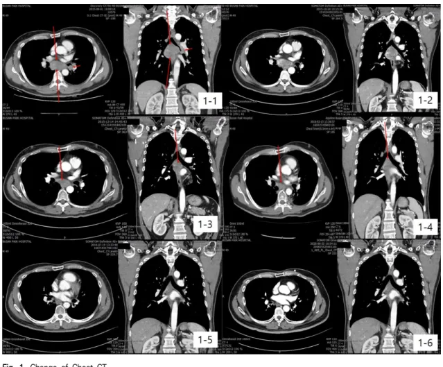 Fig.  1.  Change  of  Chest  CT