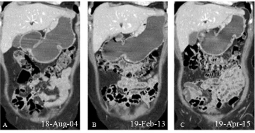 Fig.  1.  Abdominal  Computed  Tomography