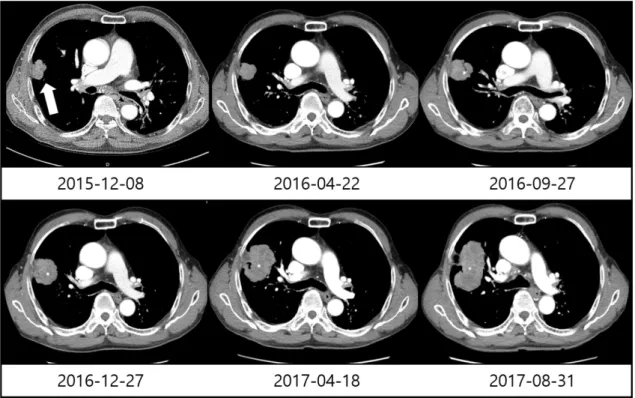 Fig.  1.  A  chest  CT  scan  dated  December  8,  2015  revealed  an  approximately  3.6  cm  solid  nodule  in  the  upper  right  lobe