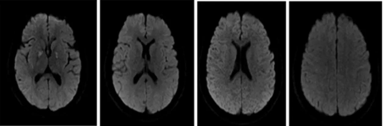 Fig. 1. Brain  MRI  DWI  of  the  date  of  the  incident 근육통,  불안,  우울증,  구토,  어지러움  등의  경미한  증상에서  신경학적  손상,  혼돈,  경련,  의식  소실,  심근경색,  뇌경색  등의  심각한  부작용을  동반하기도  하며  사망에  이르는  사례도  있다3)