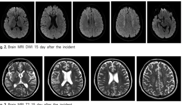 Fig. 2. Brain  MRI  DWI  15  day  after  the  incident