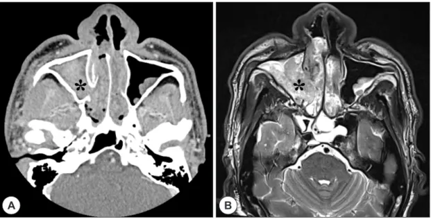 Fig. 1. Preoperative axial view of paranasal (A) computed tomography and (B) magnetic resonance imaging