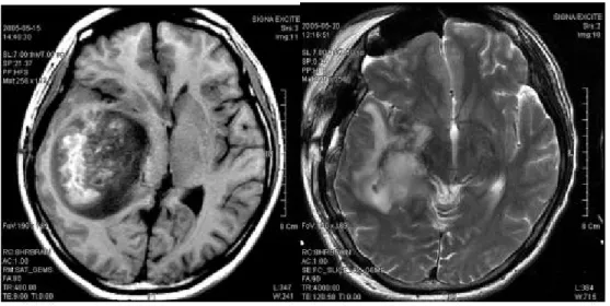 Fig  1. Brain MRI before and after the First Surgery (2005.05.19) Lt : before (2005.05.15), Rt: after (2005.05.20)