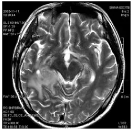 Fig.  3. Brain MRI (2006. 06.27)
