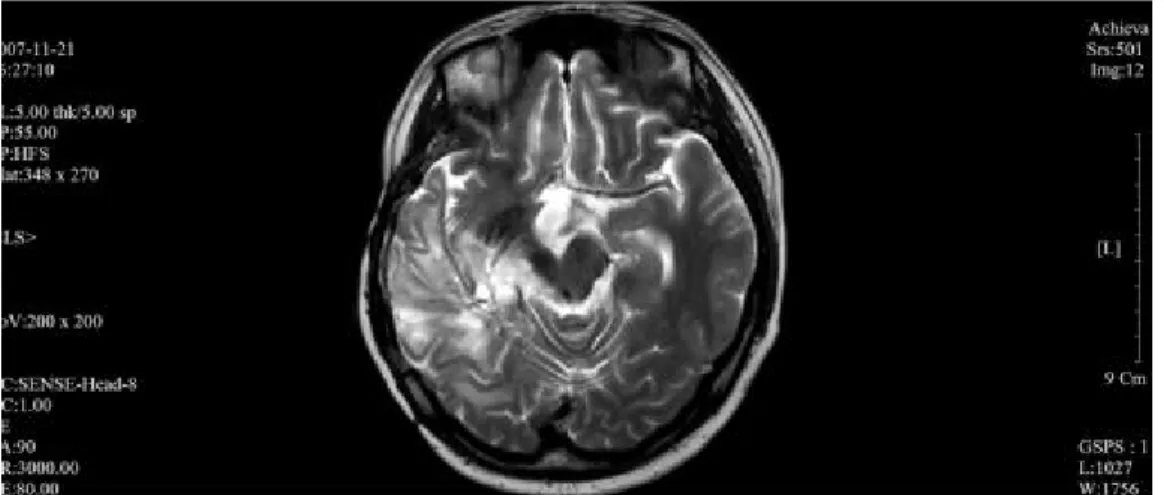 Fig.  5. Brain MRI Suspicious of Tumor Progression (2006.11.21) 6g,  大棗  2매(6g)  가감:  黃柏,  天麻,  茯苓,  澤瀉,  靑蒿,  知母,  地骨皮  등을  증상에  따라  가미하고  소양열이  심할  때는  黃芩을  증량함 ④  보안만령단 (保安萬靈丹) (10환씩 1일 3회 복용