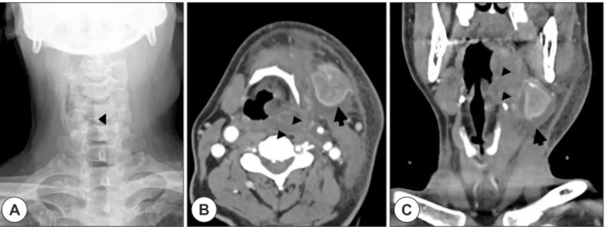 Fig. 2. Neck radiologic exam. Shows simple neck radiography showing airway deviation to the right side in the larynx  level (arrow head) (A)