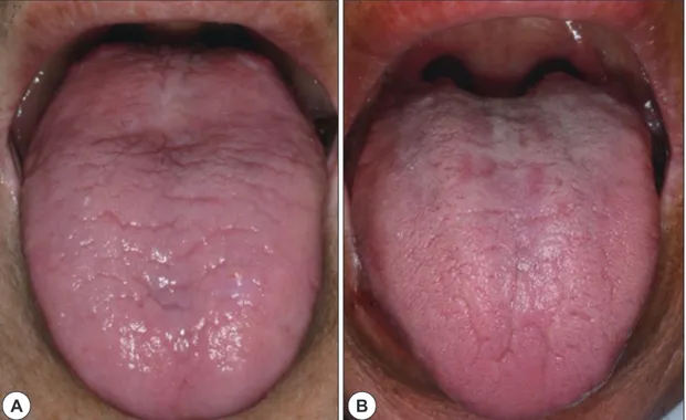 Fig. 2. Photographs of patient’s tongue. A: The tongue appeared red and smooth. The papillae were not visible on  the lingual dorsum
