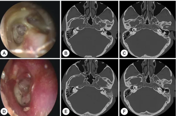 Fig. 2. Representative case. Pre- and Postoperative findings in patients with cholesteatoma in the left ear