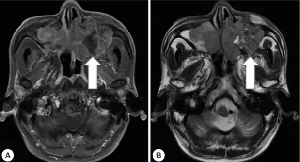 Fig. 3. MRI image showing a large enhanced mass which invades surrounding soft tissue (A: T1 axial view, B: T2 axial  view).
