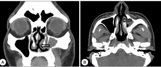 Fig. 2. Preoperative computed tomography findings showed the septal perforation (2.0×1.2 cm)