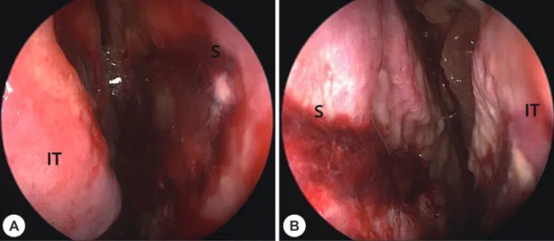 Fig. 3. Postoperative 2 weeks endoscopic findings. A: Right nasal cavity. B: Left nasal cavity