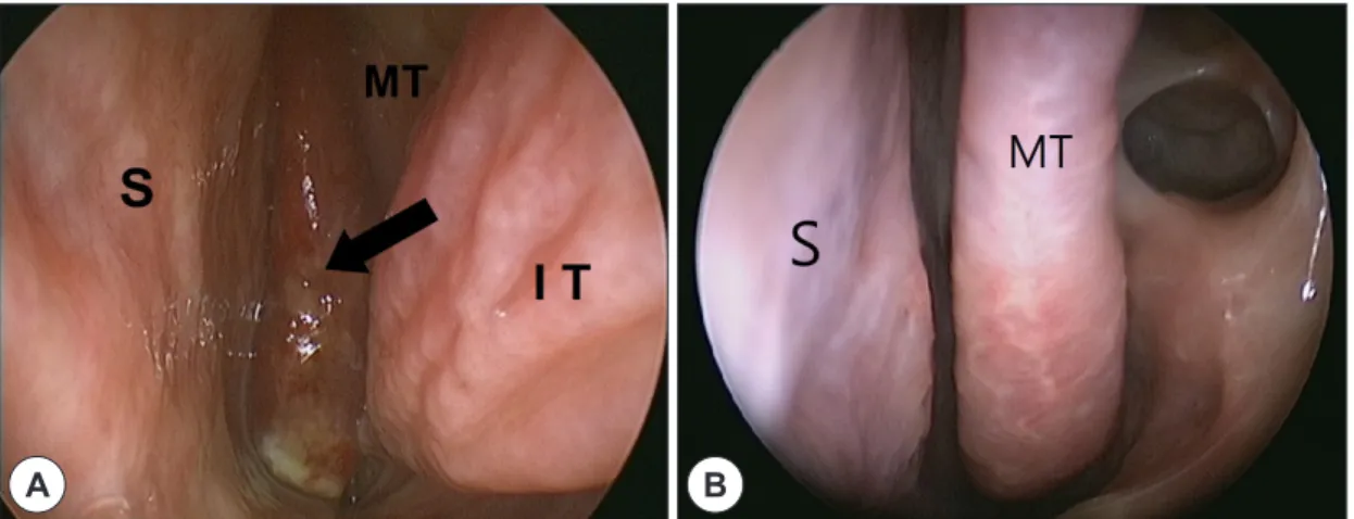 Fig. 1. Endoscopic findings. (A) Preoperative nasal endoscopy reveals a reddish mass extending from the left spheno- spheno-ethmoidal recess to the left nasal floor