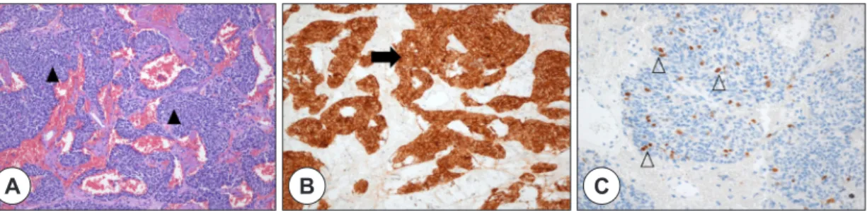 Fig. 3. Histopathology and immunohistochemistry. (A) Microscopic findings shows irregular trabecular pattern sep- sep-arated by fibroconnective stroma (black arrow heads, hematoxylin and eosin, 100×)