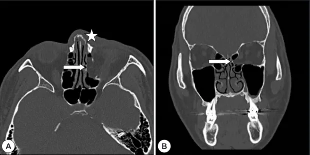 Fig. 1. Preoperative computed tomography findings. Axial (A) and coronal (B) image showed Lt