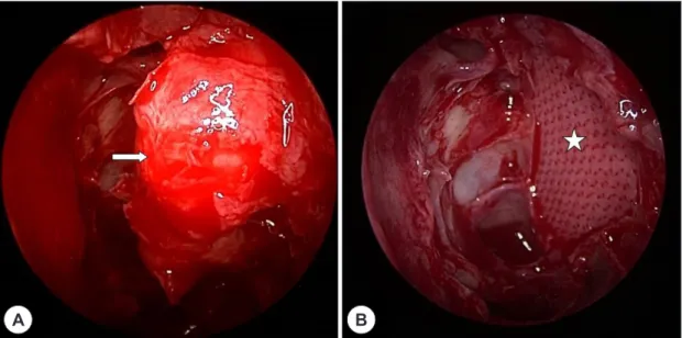 Fig. 2. Intraoperative finding. Intraorbital tissue (arrow) is herniated from original site (A)