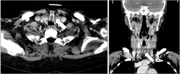 Fig. 1. Preoperative CT axial &amp; coronal views (white arrow indicates granulation tissue inside the tube).