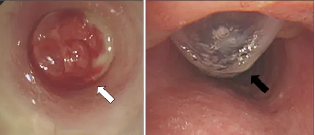Fig. 3. Pre-op(fixed tube state with granulation).