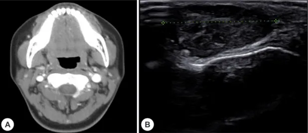 Fig. 1. Preoperative radiologic findings. A : Preoperative contrast enhanced neck CT axial view