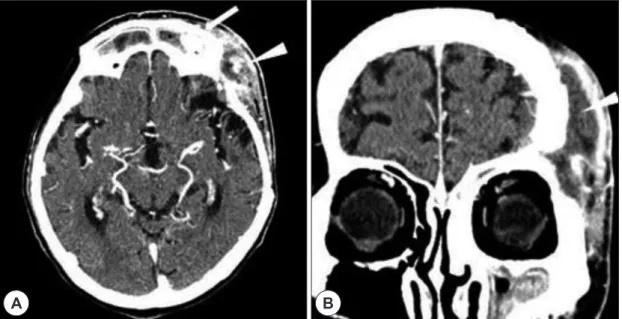 Fig. 1. Preoperative axial brain computed tomography finding shows low density lesion in both frontal sinus and sub- sub-galeal abscess (white arrow head) in left frontotemporal area