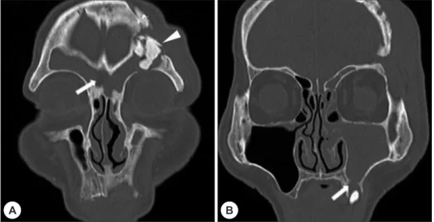 Fig. 2. Coronal imaging of the non-enhanced paranasal sinus computed tomography. Artificial bone fragments  (white arrow head) in left frontal sinus and communication between the both frontal sinuses (white arrow) (A)