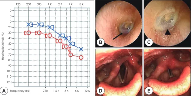 Fig. 1. Result of pure tone audiometry and physical examination images. A : Pure tone audiometry shows right mild  sensorineural hearing loss and left high-tone sensorineural hearing loss