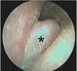Fig. 1. Otoendoscopic examination reveals a soft, non- non-tender, smooth skin-colored mass lesion (asterisk)  block-ing the external auditory canal.