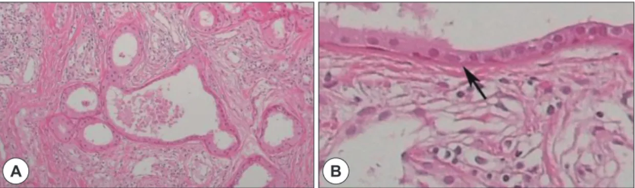 Fig. 3. Histopathological examination of the mass. Low magnification shows that the dermis contains a cystic structure  with multiple sweat gland (Hematoxylin &amp; eosin)(A)