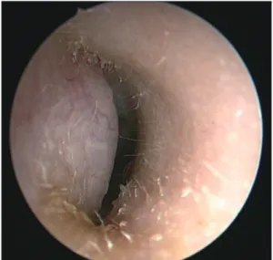 Fig. 3. Preoperative contrast enhanced MRI scan. A : T1-weighted MRI shows about 1.2×1.1×1.1 cm sized well de- de-fined mass with high signal intensity in right external auditory canal (blue arrow)
