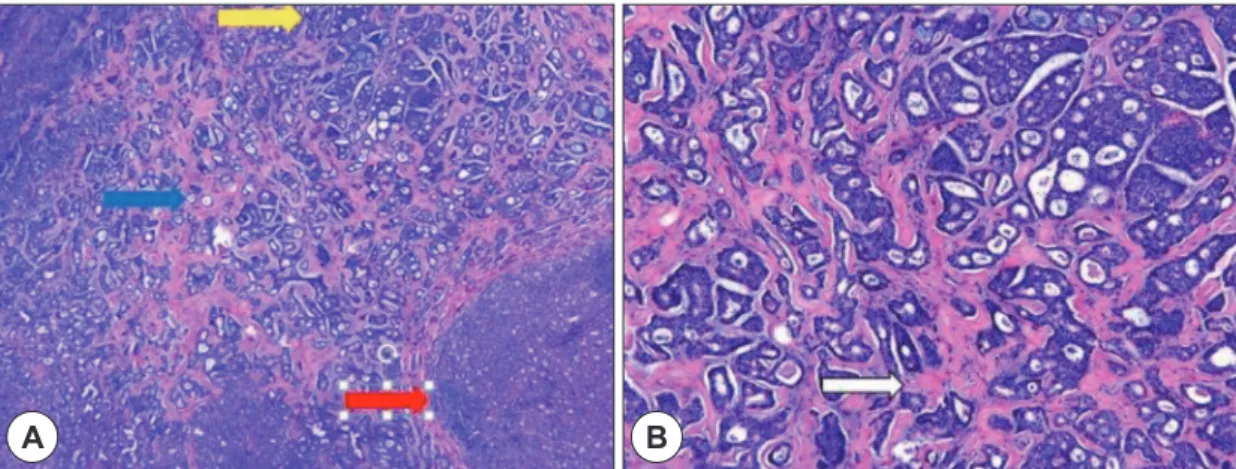 Fig. 5. Post operation finding. Excision of right external au- au-ditory mass was done