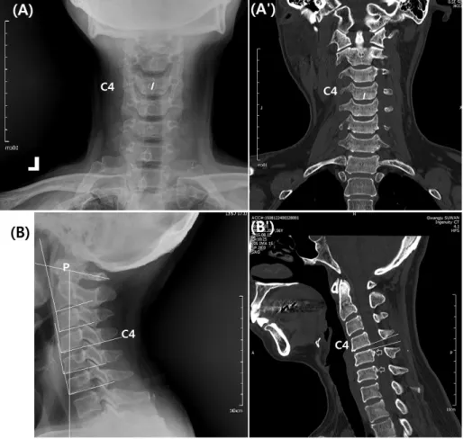Fig. 1. Cervical spinal malposition with OPLL at C5 and C6 body levels.