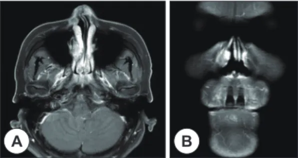 Fig. 3. Full-thickness skin, soft tissue, inner mucosal lining,  lower part of right nasal bone, medial part of frontal  process of maxilla, entire upper lateral cartilage, lateral  part of alar cartilage, dorsal segment of septal  carti-lage and inner lin