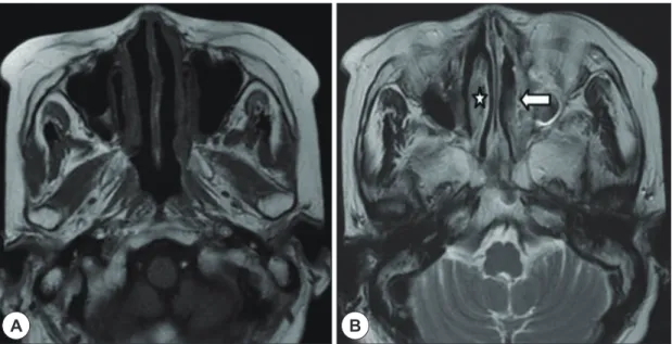 Fig. 3. Axial view of paranasal sinus MRI scan, Axial T1-weighted sequence through the left inferior turbinate shows  isointense to brain (A) but, T2-weighted sequence through the inferior turbinates shows low signal intensity along the  left nasal turbina