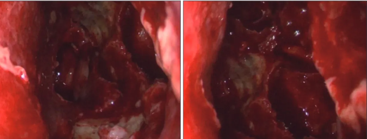 Fig. 7. Postoperative endoscopic finding of left nasal cavity after 2nd operation that done mega-antrostomy and re- re-moved necrotized mucosa of nasal cavity.